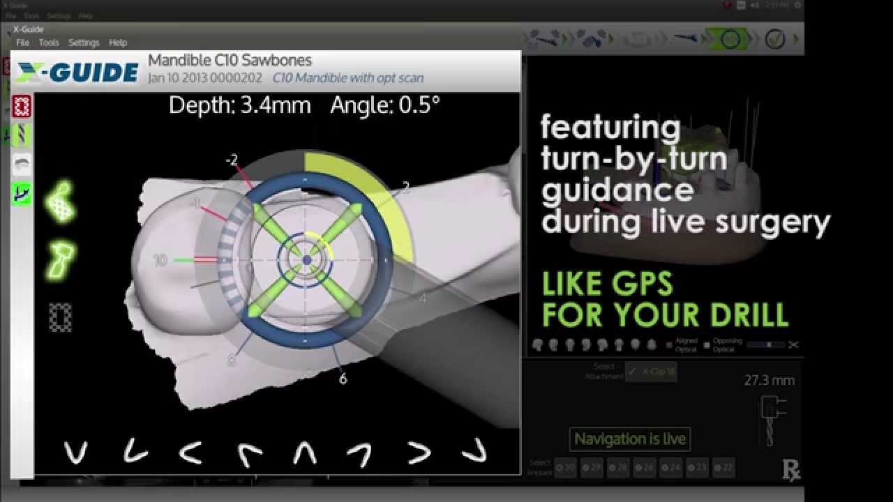 Intro Demo for the X-Guide Dynamic 3D Navigation System Video Thumbnail